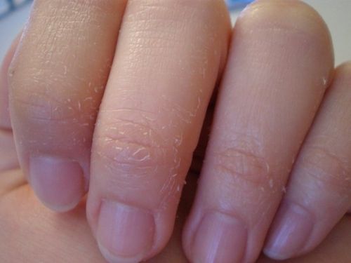 Peeling pielea degetelor copilului, pielea copilului