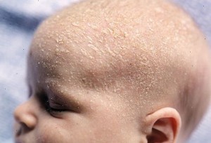 Лущення шкіри у немовляти