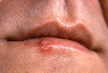 Симптоми раку губи - як їх розпізнати