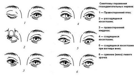 A konvergens kancsal gyermekek (kezelésében esotropia) A konvergens kancsal gyermekek