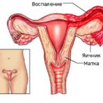 Trichomoniasis perioada de incubație la femei și bărbați