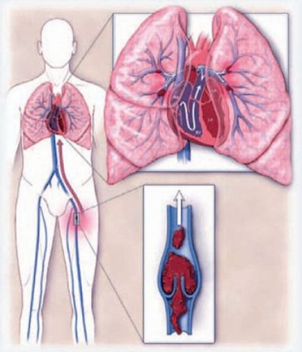 Tromboembolismul arterelor pulmonare