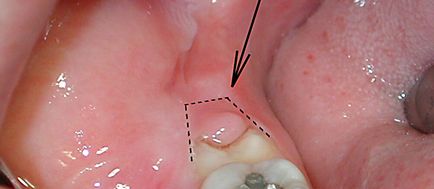Copilul are o durere de dinți - cum se determină cauza și se prescrie tratamentul potrivit