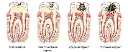 A gyermek egy fogfájás - hogyan kell meghatározni az okát, és megfelelő kezelés
