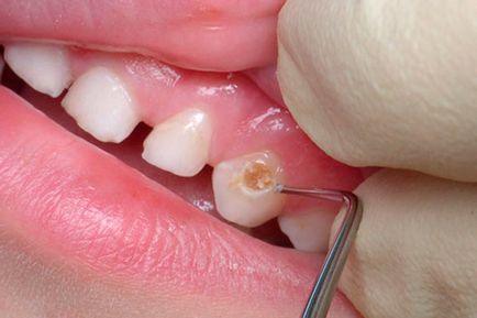 Copilul are o durere de dinți - cum se determină cauza și se prescrie tratamentul potrivit