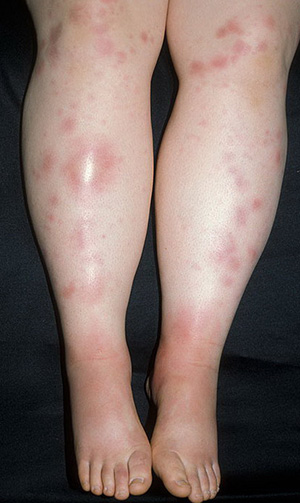 Eritemul nodular pe picioare ceea ce este, semne, simptome, tratament la copii și adulți