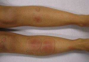 Erythema nodosum a lábak kezelésére és megelőzésére