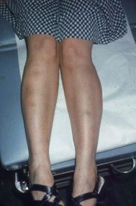 Erythema nodosum a lábak kezelésére és megelőzésére