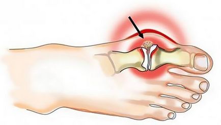 Valgus bandaj de noapte-fixator pentru tratamentul deformării degetului mare pe picior de noapte valgus