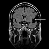 Tulburarea intracraniană asemănătoare tumorii