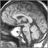 Tulburarea intracraniană asemănătoare tumorii