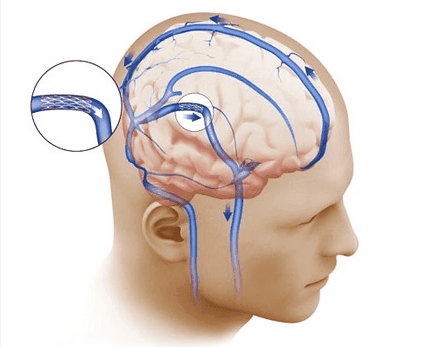 Intracranialis nyomás - a jelek, tünetek kezelésére (koponyán belüli) Intracranialis nyomás - a jelek, tünetek kezelésére