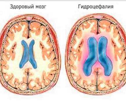 Intracraniană - semne, simptome, tratament