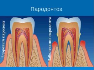 Inflamația gingiilor și respirația urâtă cauzată de cauze și de tratament