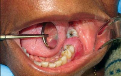Ínygyulladás után fogat, mint a gyógyítás