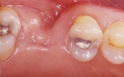 Inflamația gingiilor după extracția dinților decât cea tratată