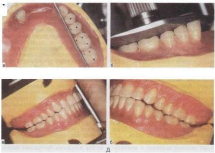 Elzáródás Recovery kivehető fogpótlások hiányában a fogak egyik vagy mindkét pofa