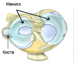 Totul despre meniscul medial, schimbările degenerative ale cornului