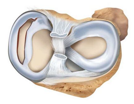 Minden, ami a mediális meniscus, degeneratív változások hátsó szarv (meniszkusz) Minden, ami a mediális meniscus hátsó szarvának degeneratív elváltozások