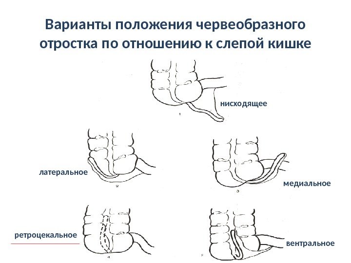 Tactica chirurgicala pentru apendicita acuta