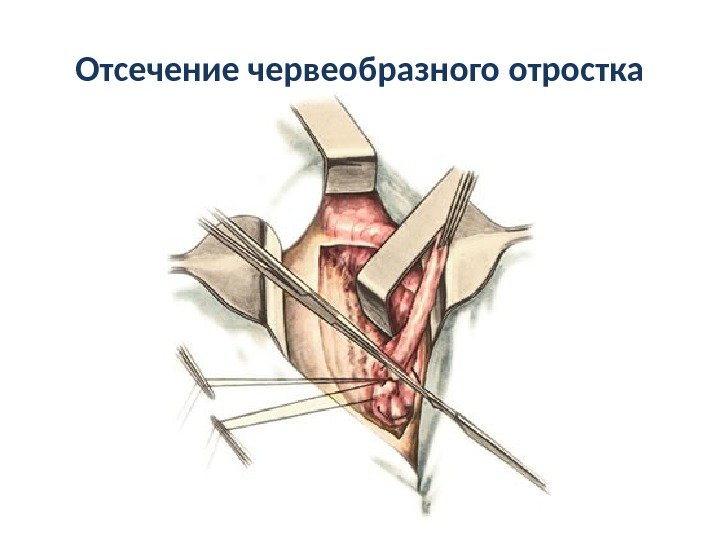 Tactica chirurgicala pentru apendicita acuta