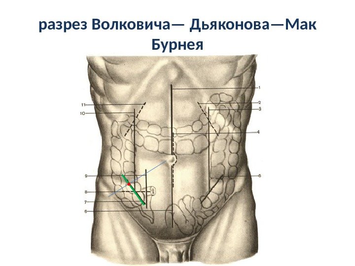 Tactica chirurgicala pentru apendicita acuta