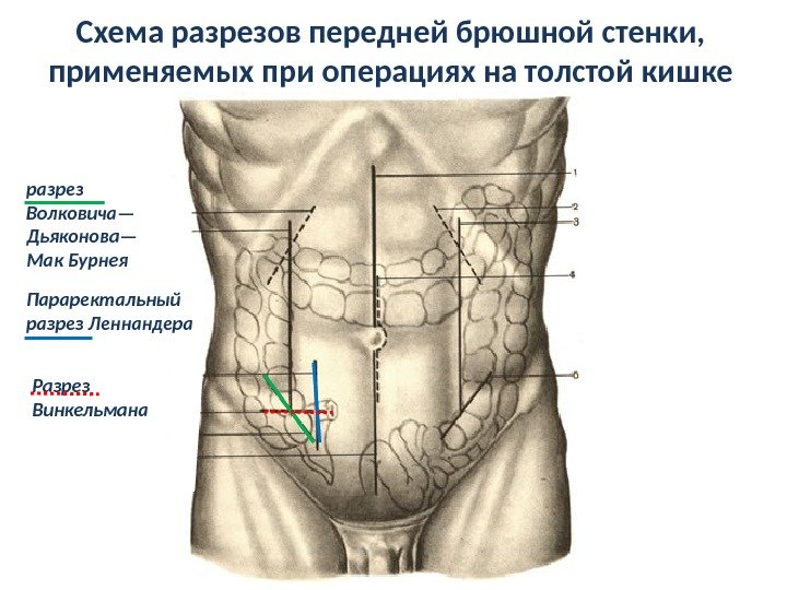 Tactica chirurgicala pentru apendicita acuta