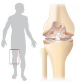 Tratamentul chirurgical al artrozei artroplastiei articulare la genunchi a artrodisei articulare la genunchi