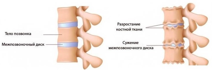 Chondroz al simptomelor coloanei vertebrale cervicale, tratament, remedii folclorice, masaj - secrete de sănătate