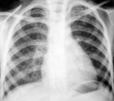 Захворювання легенів від впливу зерновий і борошняного пилу - медицина і здоров'я в світі