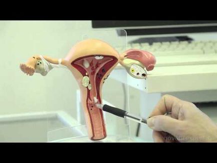 Adenocarcinomul clasificării uterului pe etape, prognoză și tratament