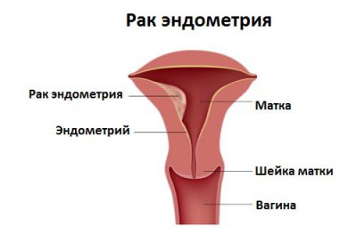 Adenocarcinomul clasificării uterului pe etape, prognoză și tratament