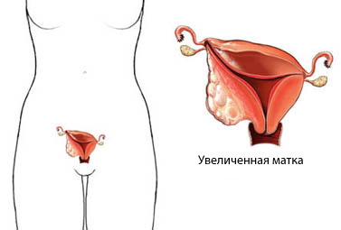 Adenocarcinomul clasificării uterului pe etape, prognoză și tratament