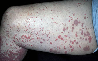 Алергічний васкуліт - симптоми і лікування (фото проявів)