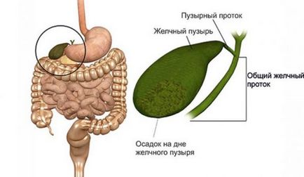 Аномалії форми жовчного міхура види, симптоми і лікування