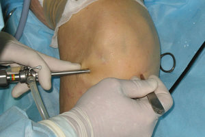 Artroscopia indicațiilor genunchiului pentru intervenții chirurgicale, recuperarea funcției articulației genunchiului și