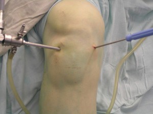 Артроскопія коліна показання до проведення операції, відновлення функцій колінного суглоба і