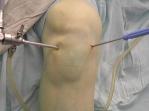 Térd arthroscopy jelzések a műtét, a hasznosítás térd ízületi funkció és