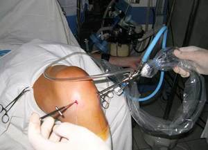 Artroscopia indicațiilor genunchiului pentru intervenția chirurgicală, recuperarea funcției articulației genunchiului și