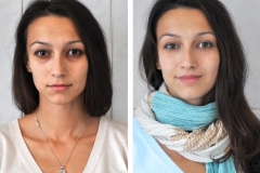 Блефаропластика до і після - верхніх повік, фото відразу після, транскон'юктівальная, азіатських очей