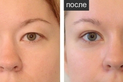 Blefaroplastia înainte și după - pleoapele superioare, fotografie imediat după, transconjunctival, ochi asiatici