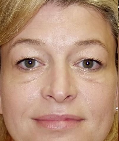 Blefaroplastia înainte și după - pleoapele superioare, fotografie imediat după, transconjunctival, ochi asiatici