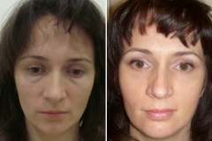 Blefaroplastia înainte și după - pleoapele superioare, fotografie imediat după, transconjunctival, ochi asiatici