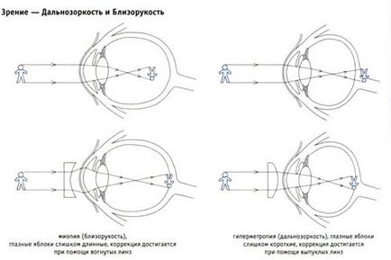 Короткозорість - причини і лікування, гімнастика і вправи для очей при короткозорості