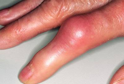 Boli ale articulațiilor mâinilor așa cum s-au manifestat și care sunt bolile