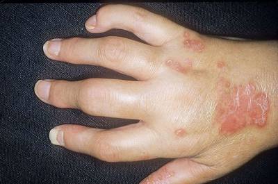 Хвороби суглобів кистей рук як проявляються і які бувають захворювання