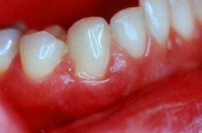 Mit lehet öblíteni a fogat terhes fáj az íny