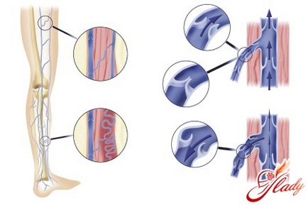 Ce este periculos pentru venele varicoase