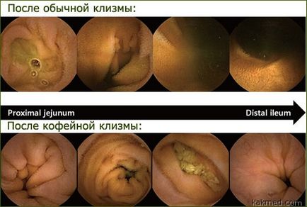 Чим корисні і шкідливі кавові клізми