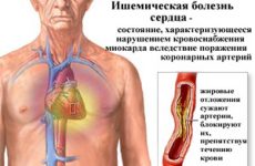 Що можна і що не можна їсти при ішемії